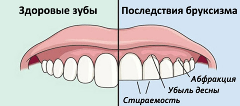 бруксизм у детей